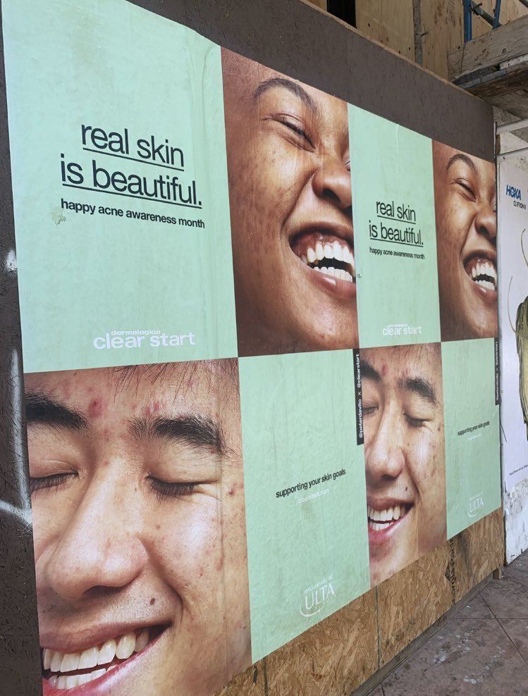 peter_devito's tweet photo. I started my “Smiling With Acne” series b/c I was tired of seeing advertisements that only showed people with acne as being depressed all the time. I wanted to take pics that showed you can have acne &amp; still be happy. Now my acne normalization images are on posters &amp; billboards🤯 https://t.co/3NWkeiOvYy