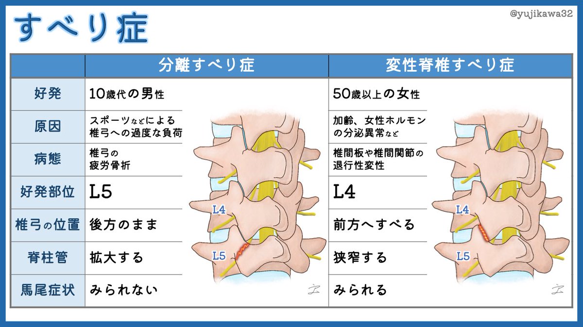 すべり症 Twitter Search すべり症 Twitter Search