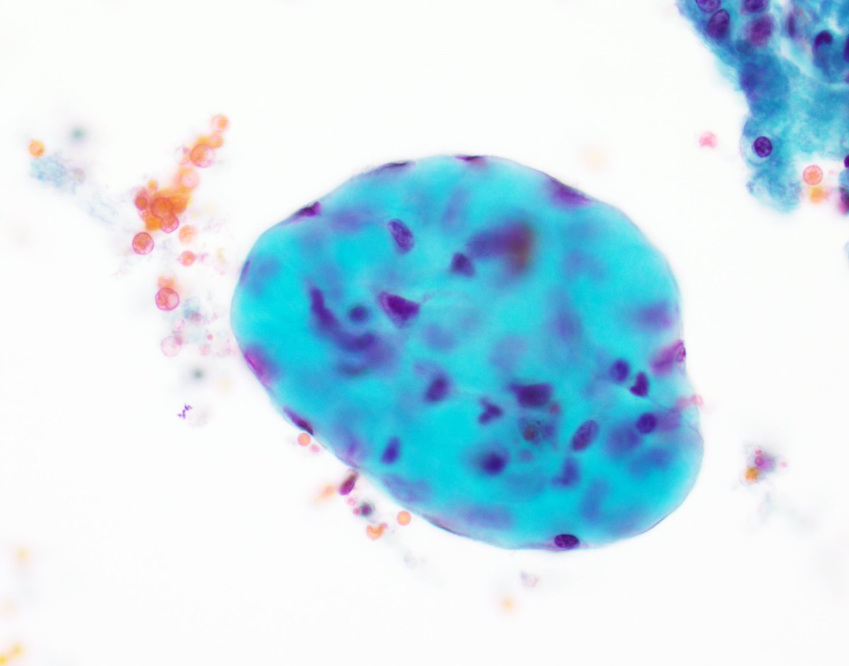 VandaTorousMD's tweet image. For trainees-&amp;gt;nice exp of collagen ball in a pelvic wash sample. Not to be confused with adenoca (which may be seen as 3D structures w community borders). Collagen balls r seen in up to half of pelvic washings &amp;amp; r spherical masses of collagen lined by mesothelial cells
#CytoPath