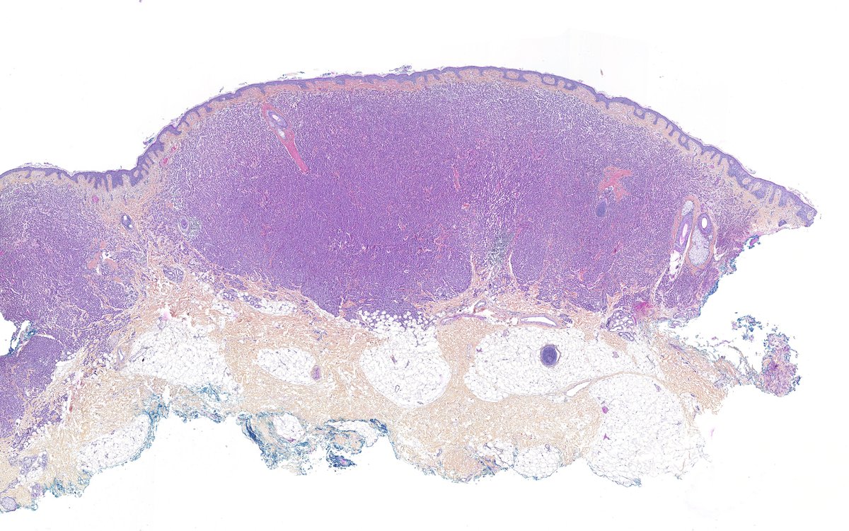 DermatopathFR's tweet photo. Mastocytose cutanée

Anecdote : saviez-vous que la mastocytose était la tumeur cutanée la plus fréquente chez le chien ? 

#francophonepath #dermpath https://t.co/dyfUUSHK0F