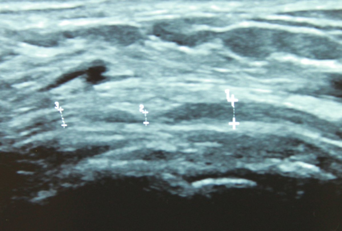 Neurodynamics's tweet image. #HEELPAIN can be produced by the MEDIAL CALCANEAL NERVE.

My patient’s pain was reproduced by palpation exactly where it was compressed. 

See site 2 - diameter is reduced with an hour-glass deformity (US).

#neurodynamics #physiotherapy #physicaltherapy #chiropractic