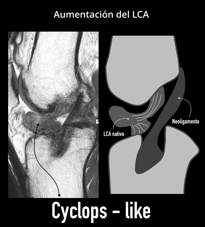 drbarousse's tweet photo. Acá recién viendo una imagen mas de estas que traen problemas. Acá no es tan difícil, se ve un LCA nativo en reconstrucción de LCA con técnica de aumentación. Este ligamento es el causante del cyclops like me parece, y también de su dolor. 7 años postQx. #Knee #LCA #Cyclops https://t.co/lyEdsrITcl
