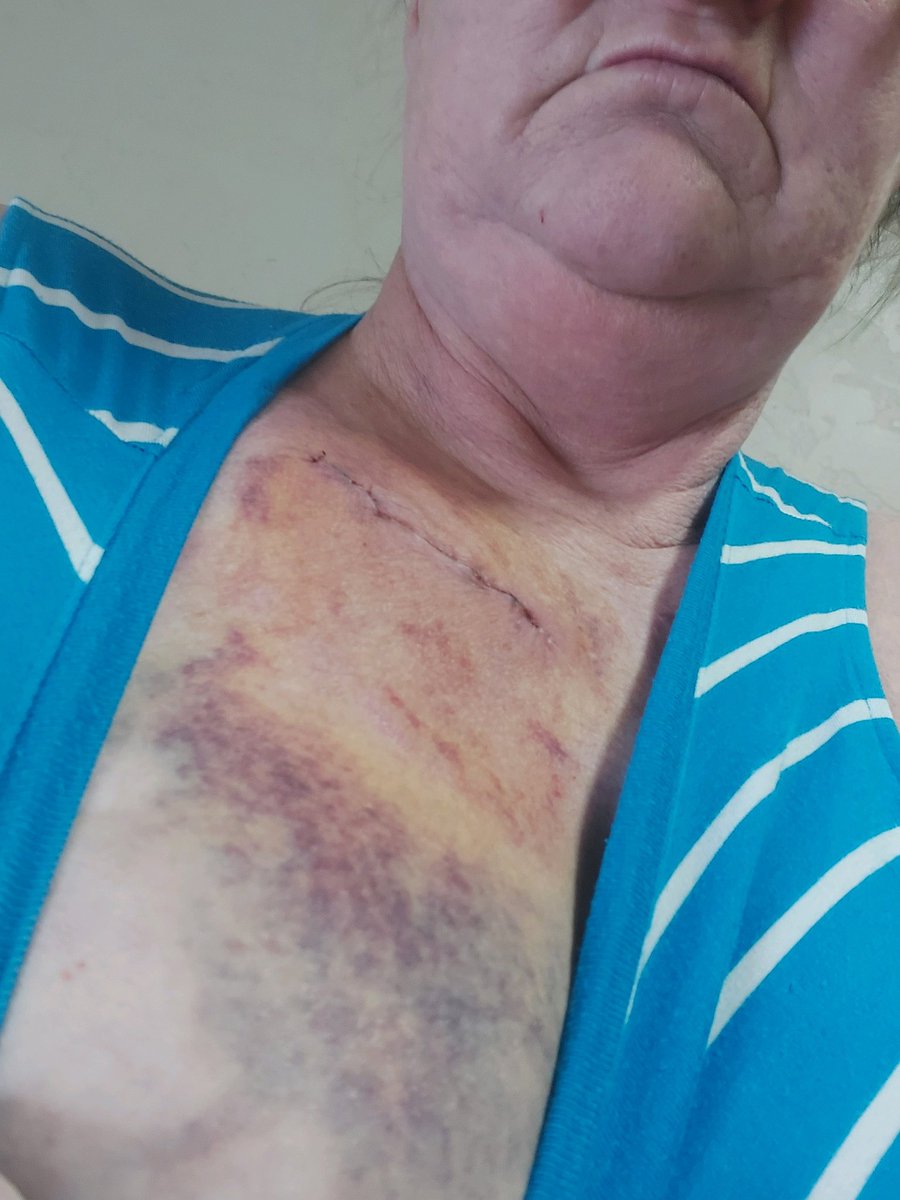 tammy_warn's tweet photo. @Thprovidence my sister went to this hospital for a needle biopsy and is now bleeding internally and has a large hematoma that is continuously growing I'm attaching pictures of what she looks like after surgery at this hospital something needs to be done. https://t.co/u6o1rZFaja