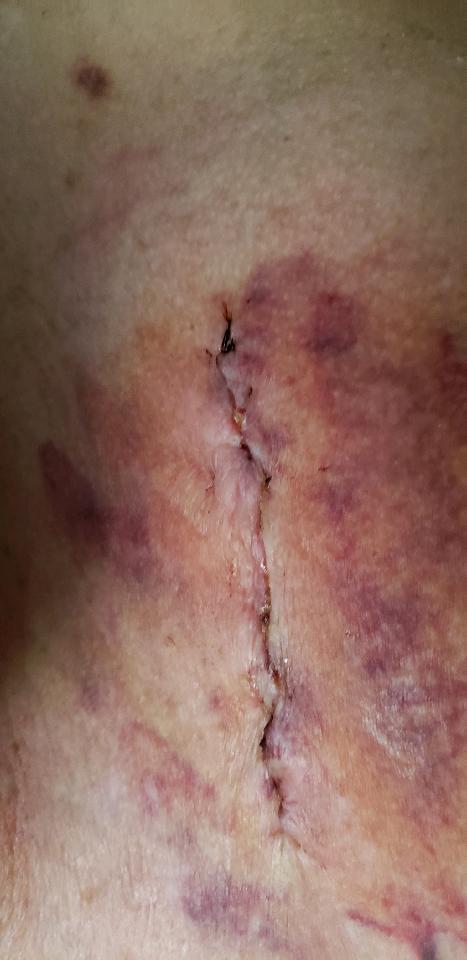 tammy_warn's tweet photo. @Thprovidence my sister went to this hospital for a needle biopsy and is now bleeding internally and has a large hematoma that is continuously growing I'm attaching pictures of what she looks like after surgery at this hospital something needs to be done. https://t.co/u6o1rZFaja