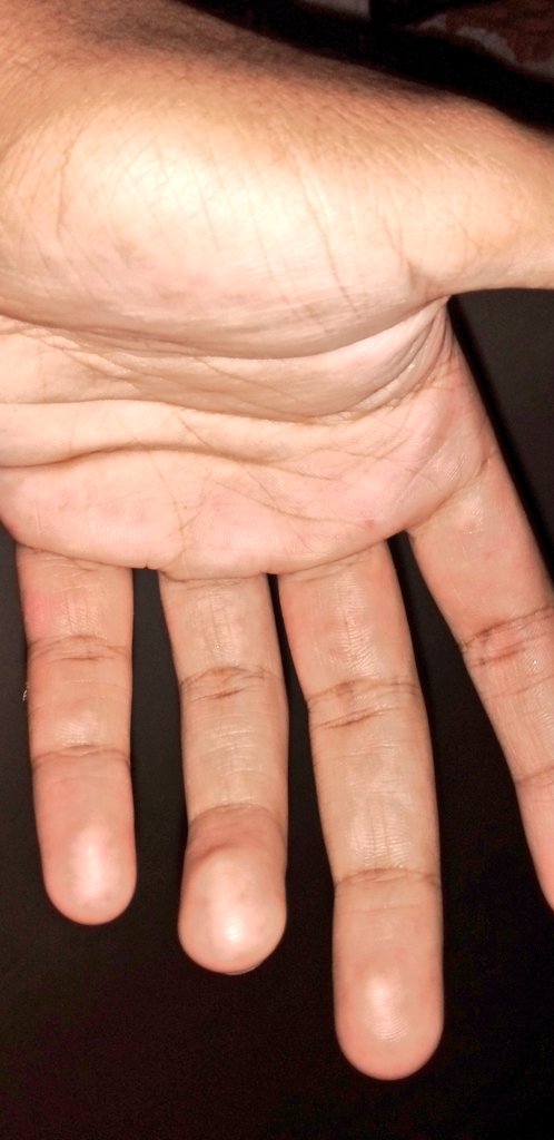 Natanaelbryan2's tweet photo. minhá mão chegar até ficar vermelho é doendo mano https://t.co/L0nk1DY1gp