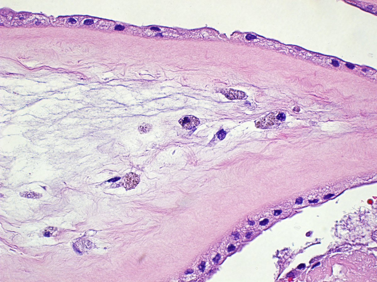 Nice example of meconium laden macrophages. #NYUpathology #pathology #MedEd #placenta