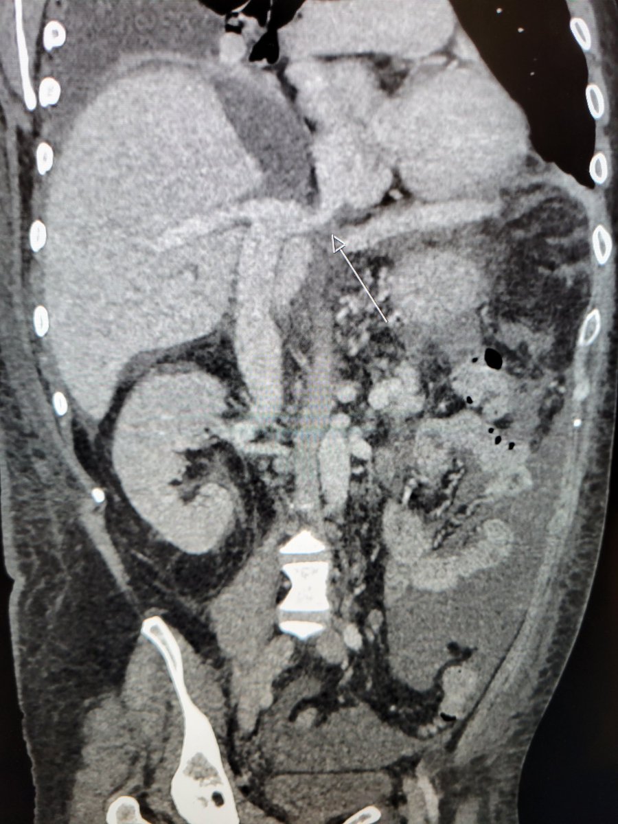 TempleRADs's tweet photo. Patient with liver transplant and hemodynamically significant venous anastomatic stenosis. Repeat recoil post angioplasty. 14mm stent placed with markedly improved gradient. Fantastic job nailing that placement by @DrSarahAbdulla @chanrahan21. @TempleRadRes @SIR_ECS @SIRRFS #IRAD https://t.co/3EzdeSnpYe