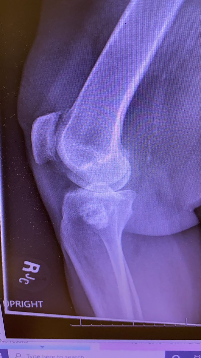 Craig Hogan (@hoganmdcraig) on Twitter photo wanting TKA. Allergy to nickel and cement on now two different patch tests. Yes not perfect test but I live in colorado so a real thing here. Benign enchondroma in tibia. How are you dealing with this?? @BoneDocMMD <a href="/DrLeeRubin/">Lee E. Rubin, M.D., FAAOS, FAAHKS, FAOA</a> <a href="/jointdocShields/">John Shields, MD, FAAOS</a> <a href="/generalorthomd/">Very General Orthopaedist</a> <a href="/RafaSierra5/">Rafa Sierra Hip Knee</a> wanting TKA. Allergy to nickel and cement on now two different patch tests. Yes not perfect test but I live in colorado so a real thing here. Benign enchondroma in tibia. How are you dealing with this?? @BoneDocMMD <a href="/DrLeeRubin/">Lee E. Rubin, M.D., FAAOS, FAAHKS, FAOA</a> <a href="/jointdocShields/">John Shields, MD, FAAOS</a> <a href="/generalorthomd/">Very General Orthopaedist</a> <a href="/RafaSierra5/">Rafa Sierra Hip Knee</a>