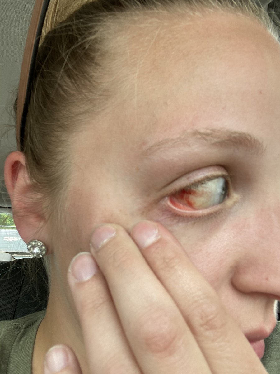 mma20148's tweet photo. This is what I get for going Kayaking 😐😐😐 #accidentprone https://t.co/cPSYdLVZEX