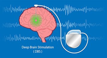 AANmember's tweet photo. New Study Published in @GreenJournal: After 15 Years, Deep Brain Stimulation Still Effective in People with #Parkinsons https://t.co/1ZGQBG1YGQ https://t.co/lusXs6eL36
