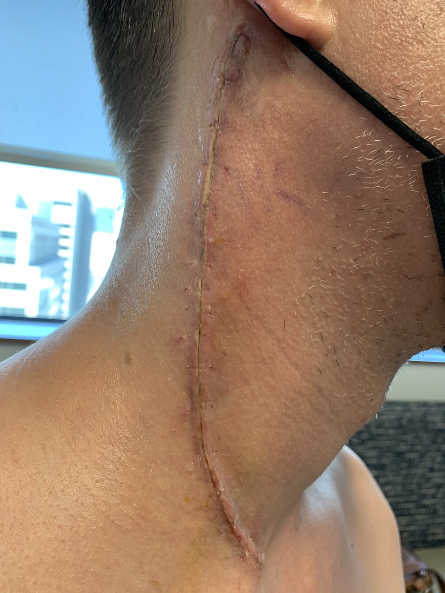Justin Wright (@bodywright) on Twitter photo Surgery last Friday, staples and drain removed today!  My vulnerability is way down, but my pain is definitely increasing. Been trying to stay at 5mg oxycodone every 4 hours but I believe I’m getting more tolerant.  Doc says 10mg isn’t too bad for someone my size.
<a href="/jenmercieca/">Jennifer Mercieca is at the BLUE place</a> Surgery last Friday, staples and drain removed today!  My vulnerability is way down, but my pain is definitely increasing. Been trying to stay at 5mg oxycodone every 4 hours but I believe I’m getting more tolerant.  Doc says 10mg isn’t too bad for someone my size.
<a href="/jenmercieca/">Jennifer Mercieca is at the BLUE place</a>