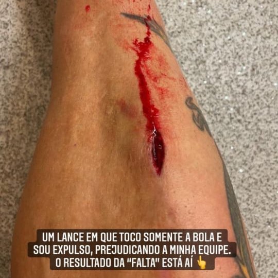 SportsCenterBR's tweet photo. OLHA COMO FICOU A CANELA DO FAGNER! O que achou da expulsão? https://t.co/Lwm2PDqO8G