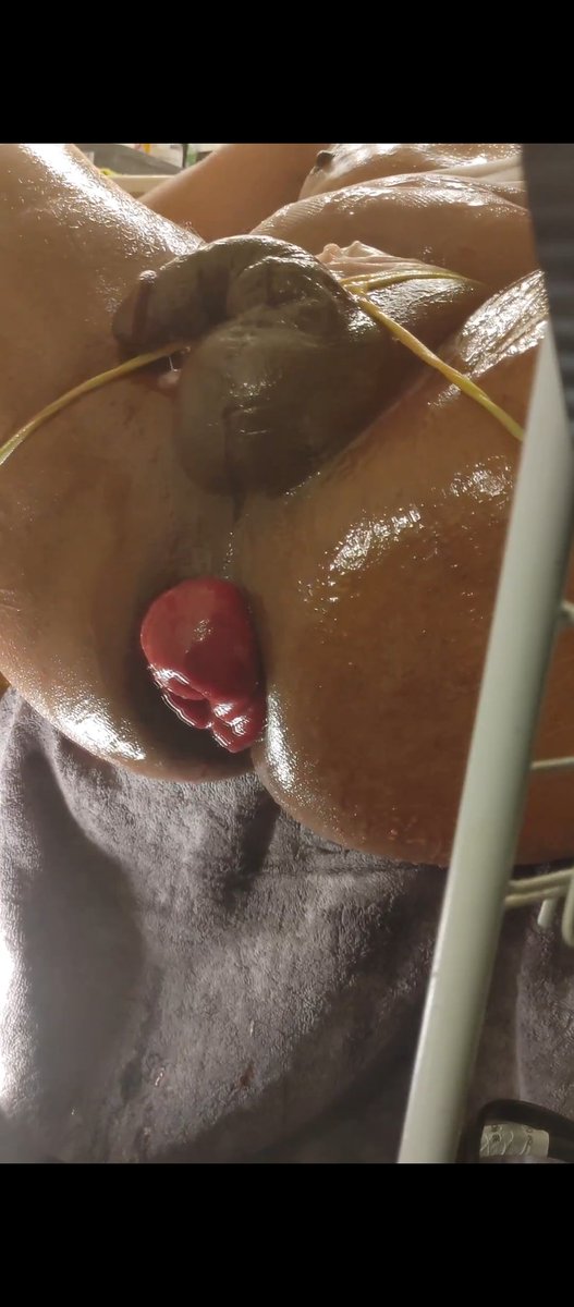 fetishjock's tweet photo. With some #prolapses, you can't really tell where you would put your dick. But with mine, there's ACTUALLY a place to fuck it. if you still can't find it I'll just pull it open for you!
#dontcumtoosoon #prolapse #rosebud #loosehole #manpussy #mancunt https://t.co/f9jcJs4mk0