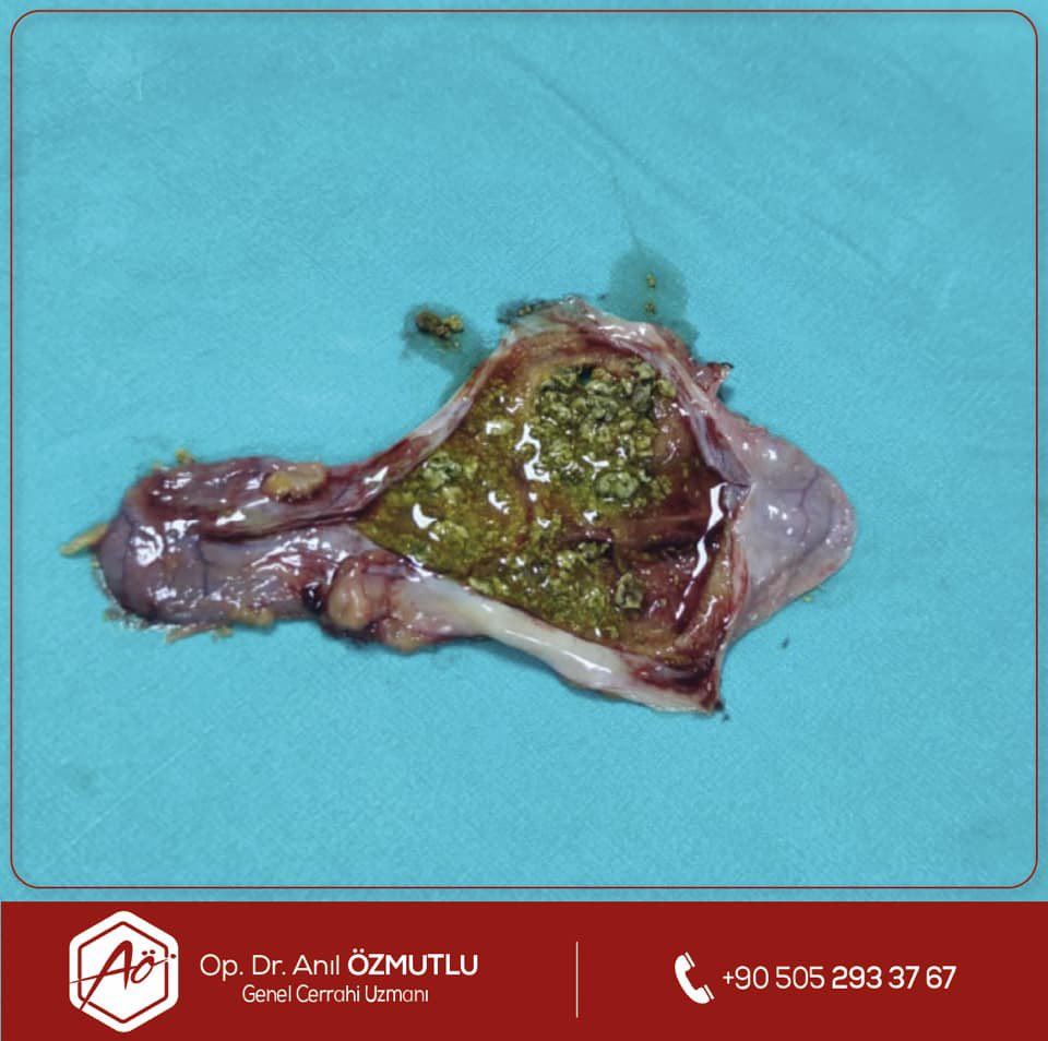 Op. Dr. Anıl Özmutlu (@opdranilozmutlu) on Twitter photo Safra kesesindeki taşlara bağlı olarak safra kesesi ve pankreasta iltihabı olan hastanın, tedavi ile pankreasta iltihabı temizlendikten sonra safra kesesi ameliyatını yaptık ve çok şükür sağlığına kavuştu :) Safra kesesindeki taşlara bağlı olarak safra kesesi ve pankreasta iltihabı olan hastanın, tedavi ile pankreasta iltihabı temizlendikten sonra safra kesesi ameliyatını yaptık ve çok şükür sağlığına kavuştu :)