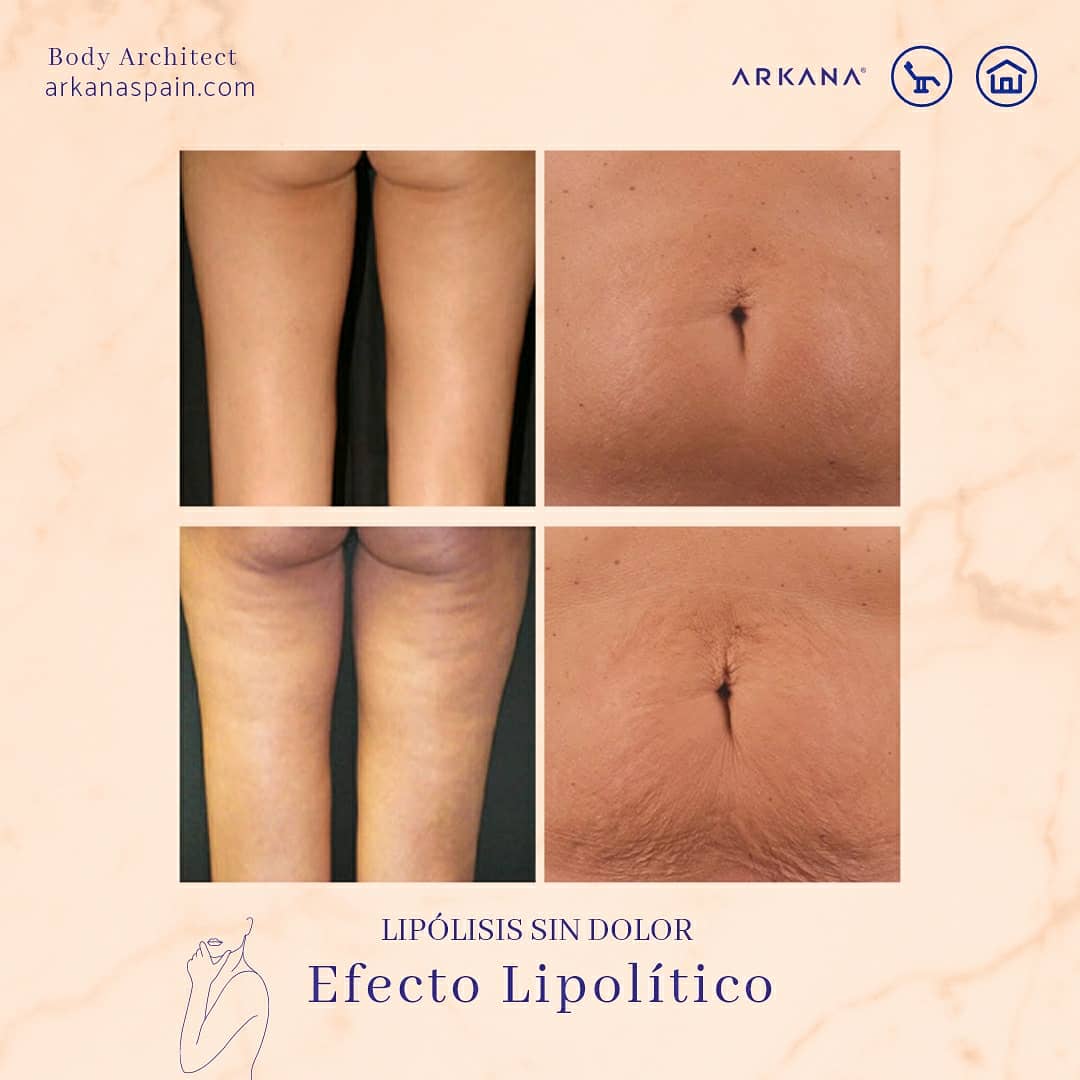 ArkanaSpain's tweet photo. 👋¿Dile adiós a la celulitis?
👩‍⚕️ Si quieres trabajar la reducción de adiposidad, eliminar la celulitis, estimular la microcirculación y activar el efecto quema grasa, nuestra terapia de efecto lipólisis es lo apropiado para el cuidado y la preparación de tu cuerpo.
#BodyLipolysis https://t.co/rG92x3njmS