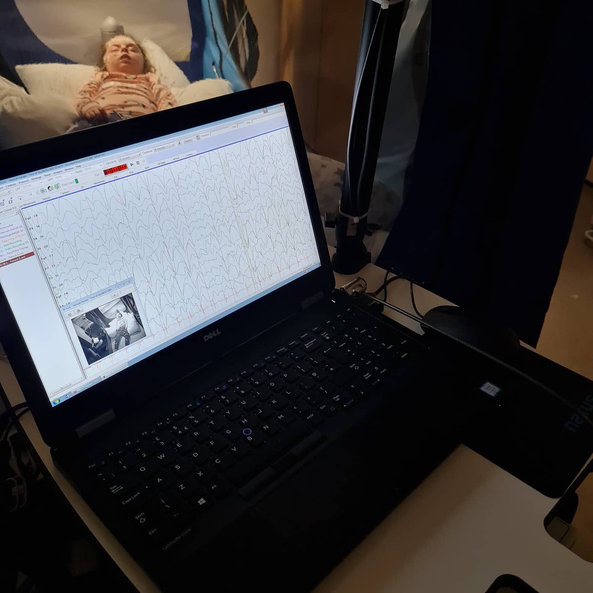 HannahMeIDD8P's tweet photo. Having 1 rare condition is sooooo last year. Why not have 2 and be ultra rare. She has a gene mutation in the #SCN1B gene which causes........... ding ding ding you guessed it...... severe childhood epilepsy #InvDuDel8p #WonkyGenes #Epilepsy #Seizures #Rare #Unique #Genetics https://t.co/VWDzmY81uY