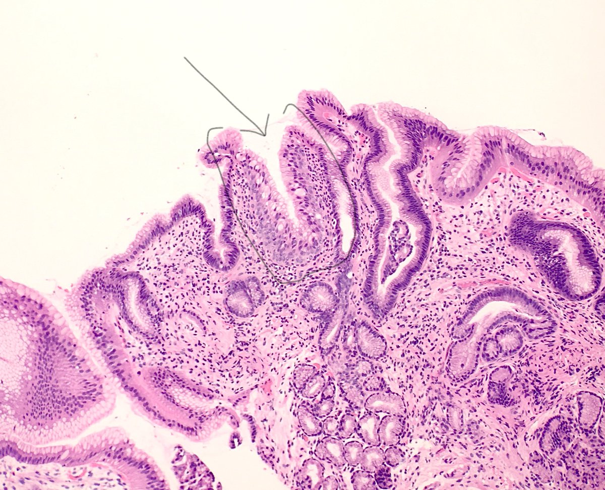 Mvgs1706's tweet photo. Just curious what people are doing with their "multilayered" epithelia these days #GIpath
Poll below
For the newbies, ME = features of both glandular and squamous epithelium 
- Strong asso w/ reflux
- Touted as precursor of columnar-lined epithel &amp; potential intestinal metaplasia https://t.co/gSG9PcsI1i