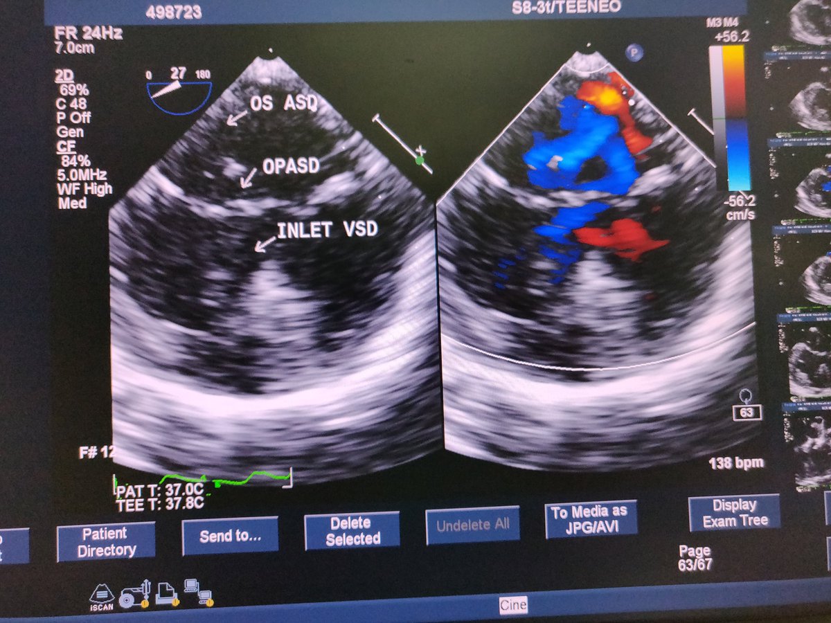 aaspari's tweet photo. Interesting: Complete ,Balanced AVSD+DORV+Proximal AP window
Suggest surgical options
#cardiotwitter #Loops #JCVA https://t.co/SljbaCsL8N