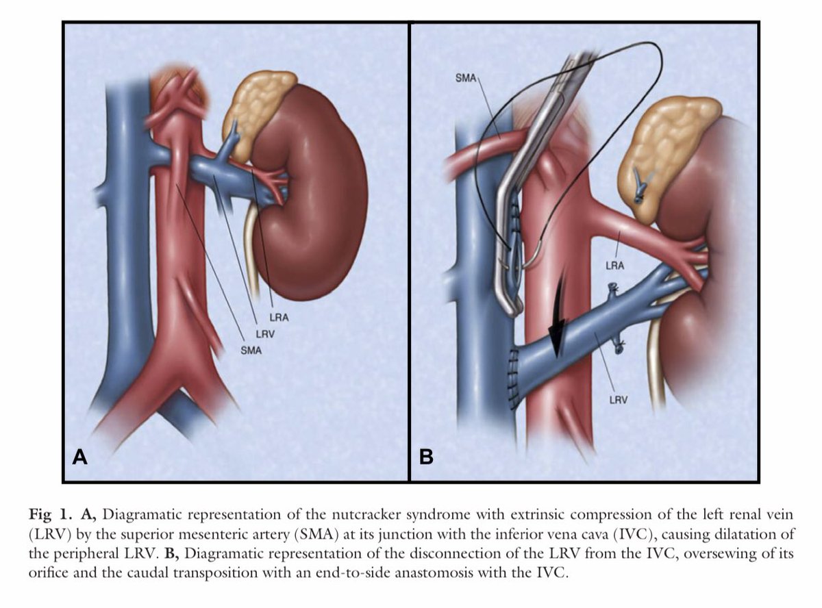 CiruAndes2's tweet photo. Left renal vein transposition for nutcracker syndrome ⤵️! #SoMe4Surgery @juliomayol @SWexner @pferrada1 @MISIRG1 @drdevirgilio @almagoch @futuroscirascol @jmills1955 @farkomd @PipeCabreraV https://t.co/LHWeRZBGjf
