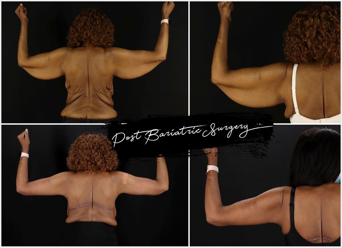 ErikaSatoMD's tweet photo. She worked her butt off and lost a ton of weight but afterward she was left with a lot excess skin. She underwent a Brachioplasty (Arm Lift) combined with a Bra Roll Excision to tighten and contour her body! https://t.co/6QCTVVU7ap