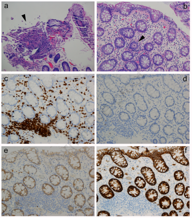 JACIInPractice's tweet image. In Press! #Crohn’s-like #enteritis in X-linked #agammaglobulinemia: A Case series and systematic review. buff.ly/3fEnwPS