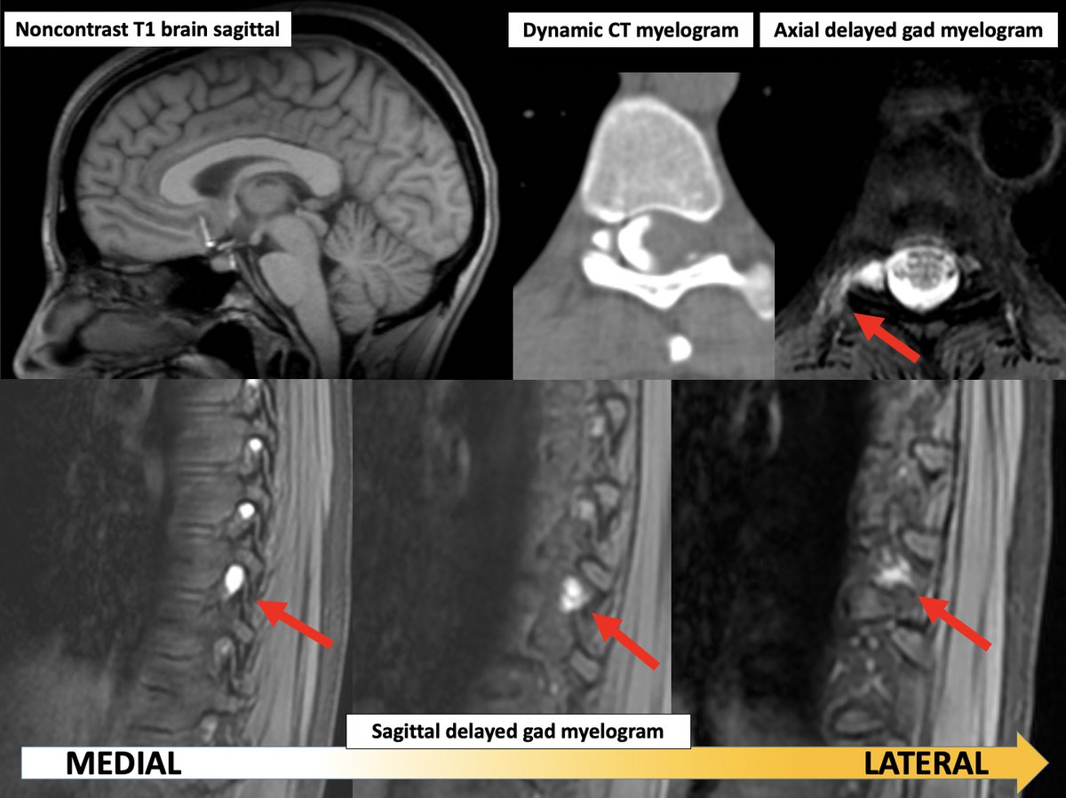 Delayed MRI myelography shows its value in a patient with orthostatic headache, very subtle intracranial MRI findings (albeit noncon) and negative dynamic CT myelography x2. Delayed MR myelography demonstrated a slow leak from a right T9-T10 perineural cyst!

#SIH #CSFleak