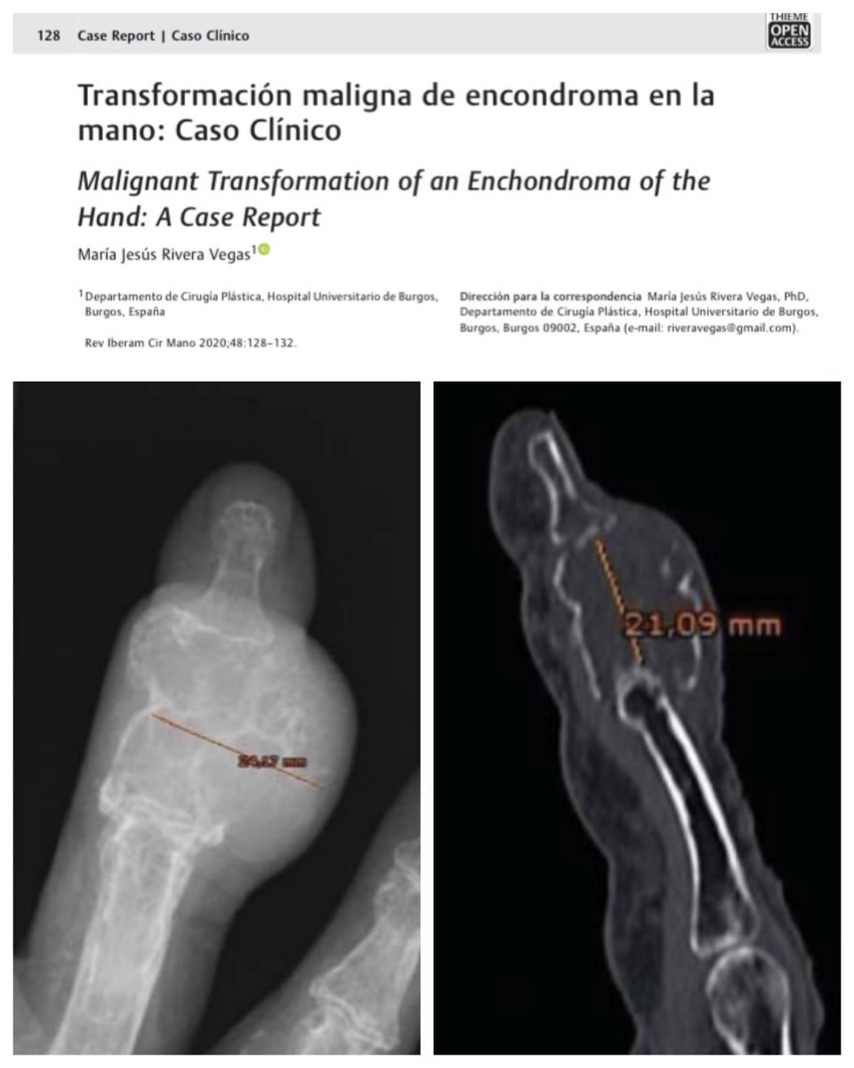 Transformación maligna de encondroma en la mano: Caso Clínico
▪️Nuevo resumen de un caso extremadamente infrecuente de transformación de un Encondroma a un condrosarcoma en la mano
▪️Link directo thieme-connect.com/products/ejour…