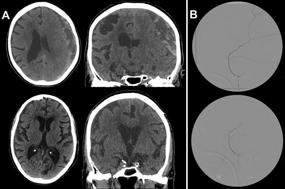 James Rutka (@jamesrutka) on Twitter photo Middle meningeal artery embolization for chronic subdural hematoma — now you see it; now you don’t! New #onlinefirst article <a href="/TheJNS/">Journal of Neurosurgery</a> Middle meningeal artery embolization for chronic subdural hematoma — now you see it; now you don’t! New #onlinefirst article <a href="/TheJNS/">Journal of Neurosurgery</a>