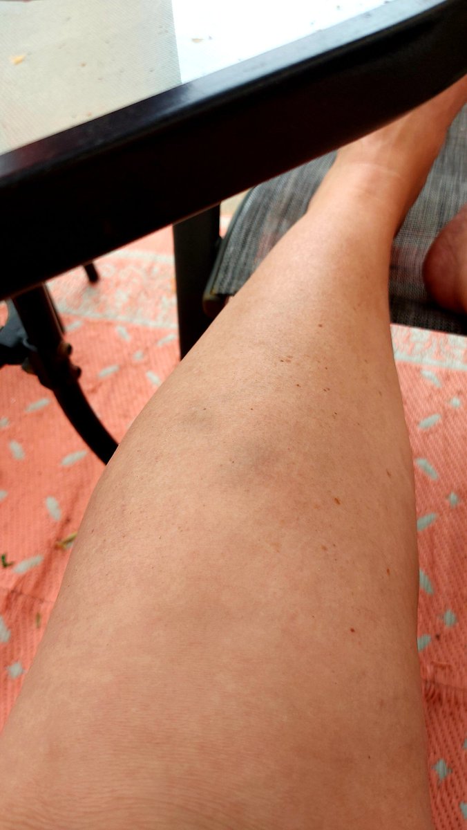 InkedDeviant's tweet photo. UPW's - Unidentified Party Wounds...
Like How...?
🤦🏼♀️🤣🤣🤣🤣🤣
#upws https://t.co/8Lunqwbeyl