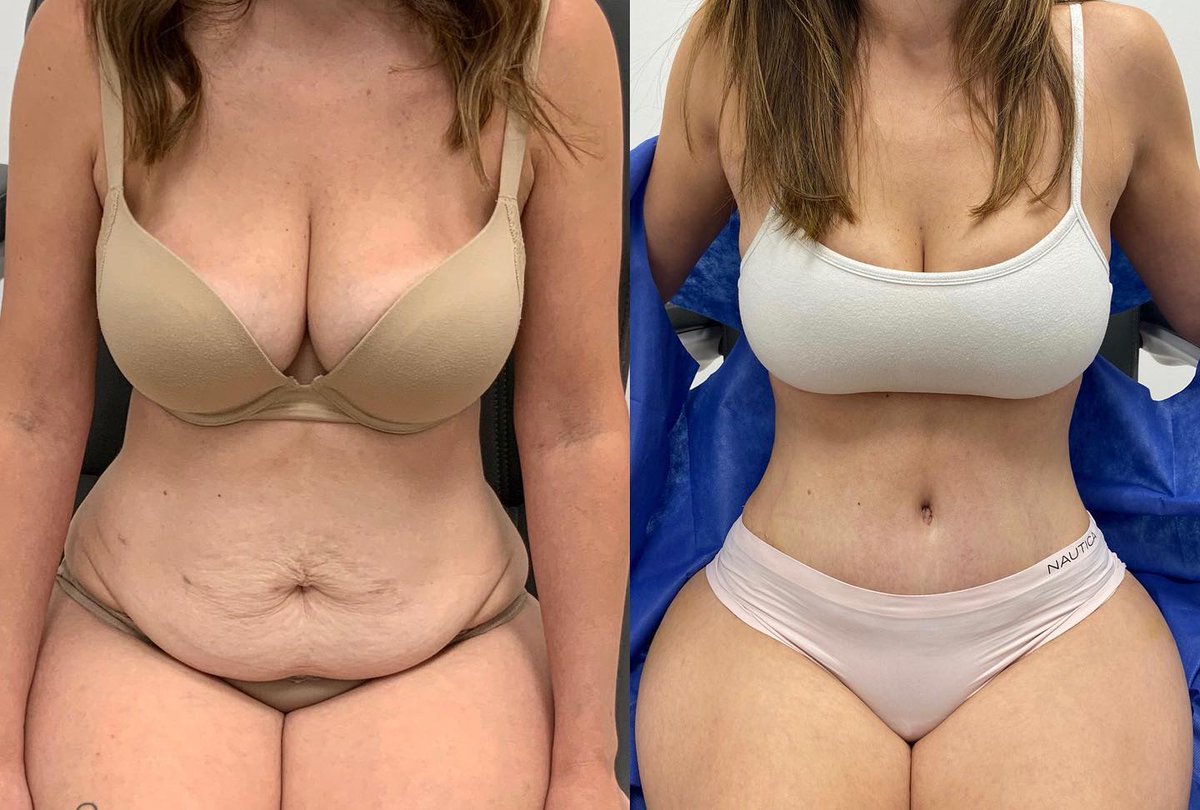 Mommy Makeover w/ a Tummy Tuck, Lipo & BBL #MomsNotModels.