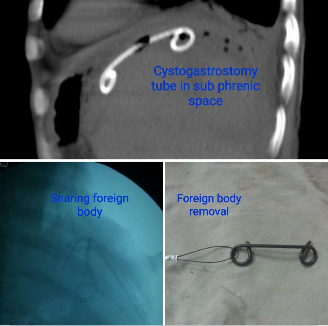 Intraabdominal foreign body removal: 
Migrated cystogastrostomy tube removal via skin puncture
#interventionalradiology