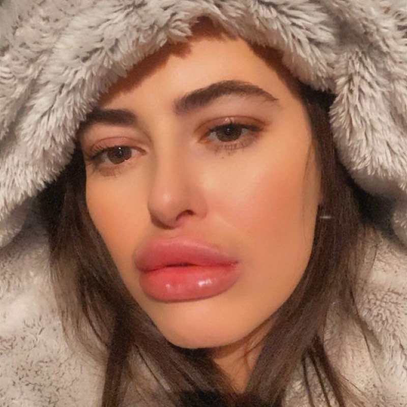 Lipaddictz's tweet photo. @kimmybooth18 Omg look at those big beautiful lips, so perfect! ππ #fake #lips #lipinjections #plastic #swollen #lipgap #juvederm #filler #addict #lipfetish #plasticsurgery #plasticpositive https://t.co/mn9yzKRaP8