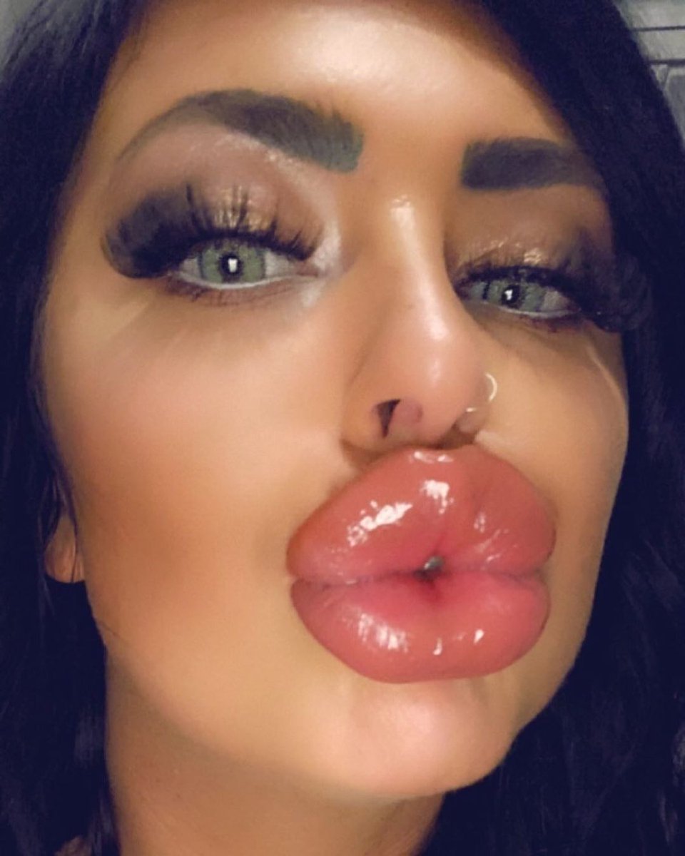 Lipaddictz's tweet photo. jadeybrooke Omg theyβre soo big! πππ #fake #lips #lipinjections #plastic #swollen #lipgap #juvederm #filler #addict #lipfetish #plasticsurgery #plasticpositive https://t.co/XQly0JHSuZ