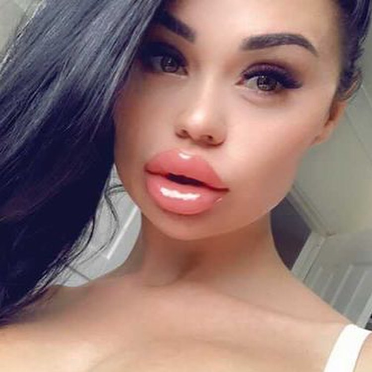 Lipaddictz's tweet photo. @AyshaSoper will always be the queen! π ππ #fake #lips #lipinjections #plastic #swollen #lipgap #juvederm #filler #addict #lipfetish #plasticsurgery #plasticpositive https://t.co/S5Fjh0itwF