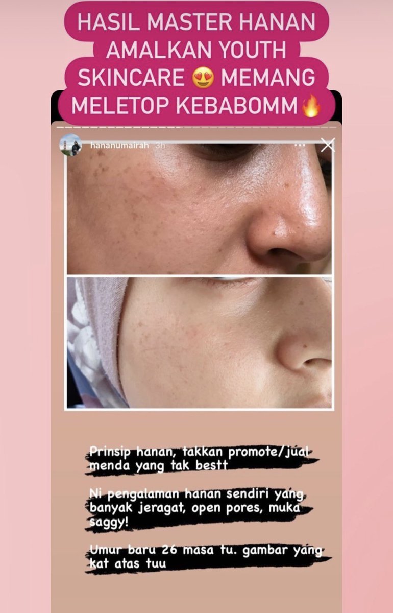 Lebih muda dari usia!😍 korang tak teringin ke nak skin sihat cantikk, bebas segala jerawat parut dan cela cela pada muka? Nak tahu lebih detail meh whatsapp nana😘 Free consultation!wasap.my/60193794776/na…