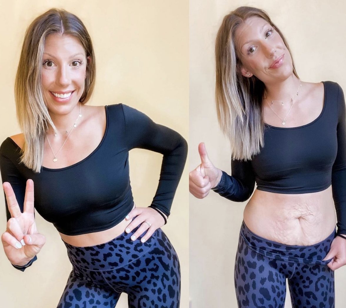 shapesofus's tweet photo. "My stretch marks and loose skin don’t make me who I am, my heart and my brain do. I know it’s tough, but please know you are so much more than your flaws 🤍"

- Shared by Bri via @bossbabewellnesss (Instagram)

#stretchmarks #bodyimage https://t.co/uHMi3EDEEX