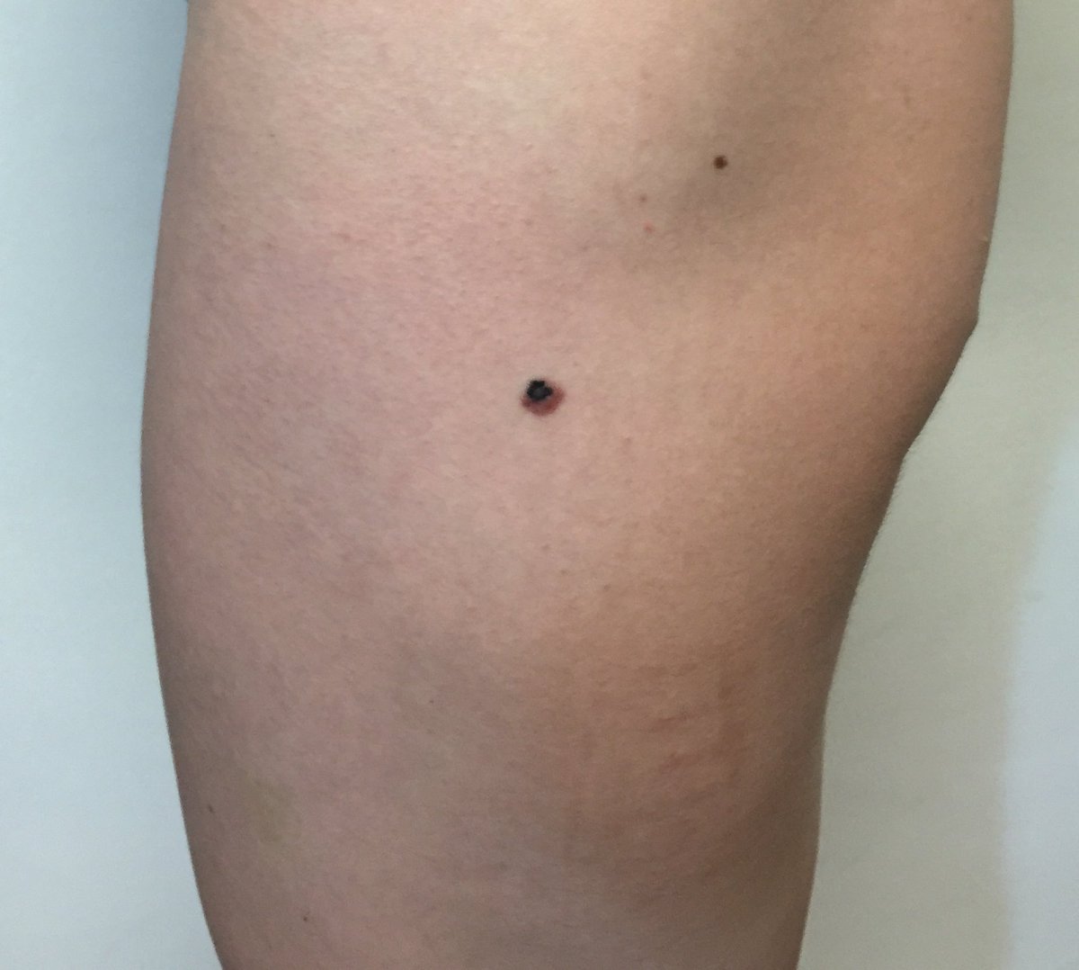telerinonline's tweet photo. Se pueden desarrollar en cualquier parte del cuerpo pero son mas frecuentes en el tronco en los varones y en las piernas en las mujeres #MelanomaAwarenessMonth #melanoma #cancerdepiel #salvatupiel #usaprotectorsolar https://t.co/cdHnmVAMLN