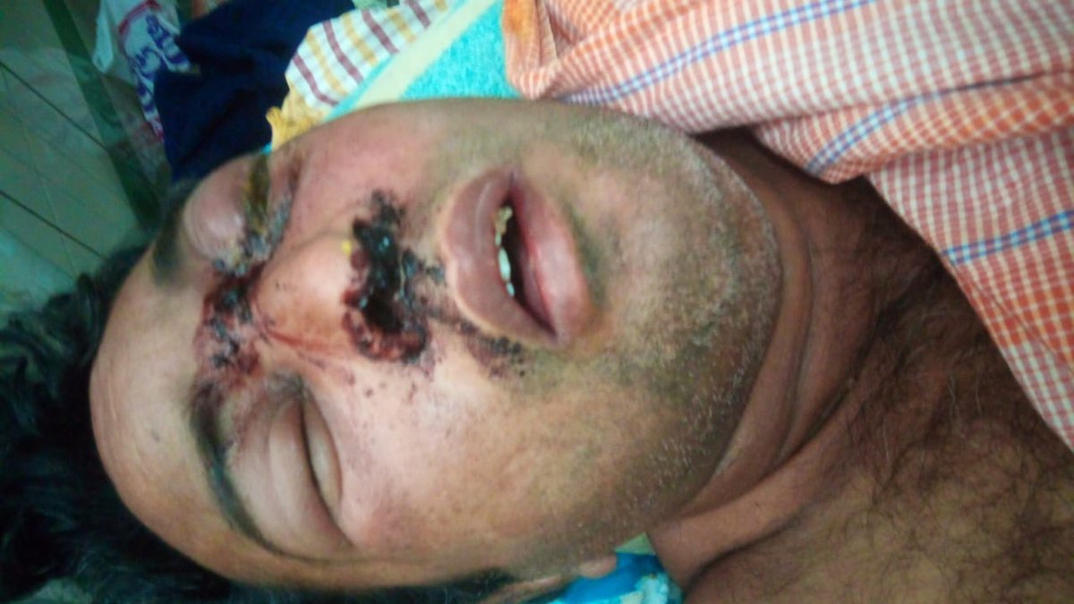 SuryaTe33303099's tweet photo. Respected @KTRTRS @KTRoffice @MinisterKTR @SonuSood 
My Friend Father was infected with Black Fungus . He Admitted in Gandhi Hospital Hyderabad From 4 
days no one was taking Care and no treatment at all , My Friend Father was in serious Condition ..Please Respond Immediately https://t.co/jJKOu6S9w4