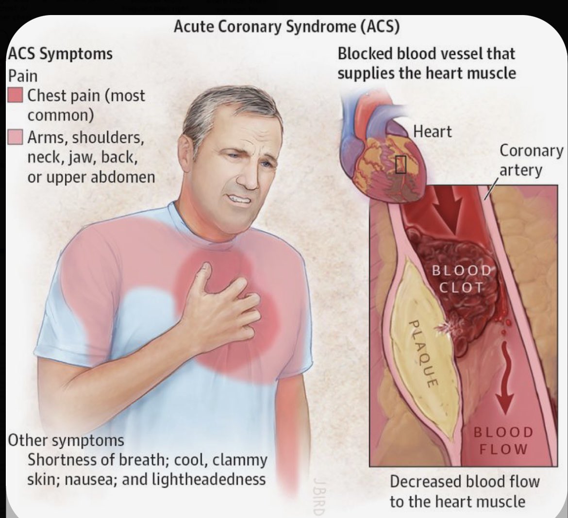 Nursing_888's tweet photo. 🔹Heart Attack (النوبة القلبية): تحدث النوبة القلبية عندما يفقد جزء من عضلة القلب إمداده بالدم جزئيًا أو كليًا  #تمريض 🤍❤️💉 https://t.co/5k7xuYvwal