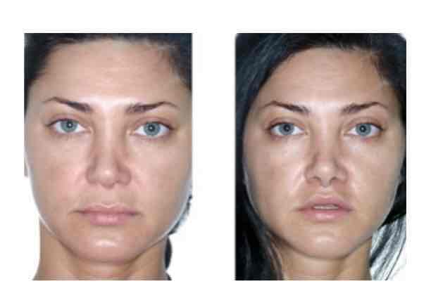 El objetivo del lip lift es acortar la longitud del labio demasiado largo. Según el diseño del lip lift que hagamos, reducimos no sólo la zona central del labio sino también la zona lateral. La cicatriz es imperceptible y el resultado inmediato.  #liplift #clinicabirbe #estetica