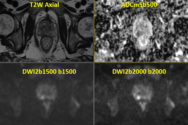 jambor_ivan's tweet photo. #RapidProstateMRIcases #100:
1.5T @SiemensHealth Aera
One large lesion in the right PZ -> #IMPRODbpMRILikert 5/5 #PIRADsv2_1 5/5
-> 4+3 to 4+5 https://t.co/fdOPQAj5SY