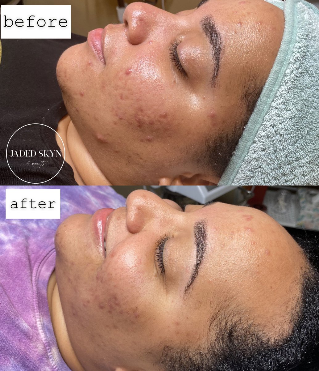 hayleytheesthi's tweet photo. Men lie, women lie, my results don’t lie though. 🤪 

This is 2 weeks progress on my Acne Bootcamp. We’ve only had one session &amp; she has been on a home care routine. I can’t wait to see her end results! 💖 

#phillyesthetician #phillyfacials #phillyskincare #phillywaxing https://t.co/lyy2670Dp4