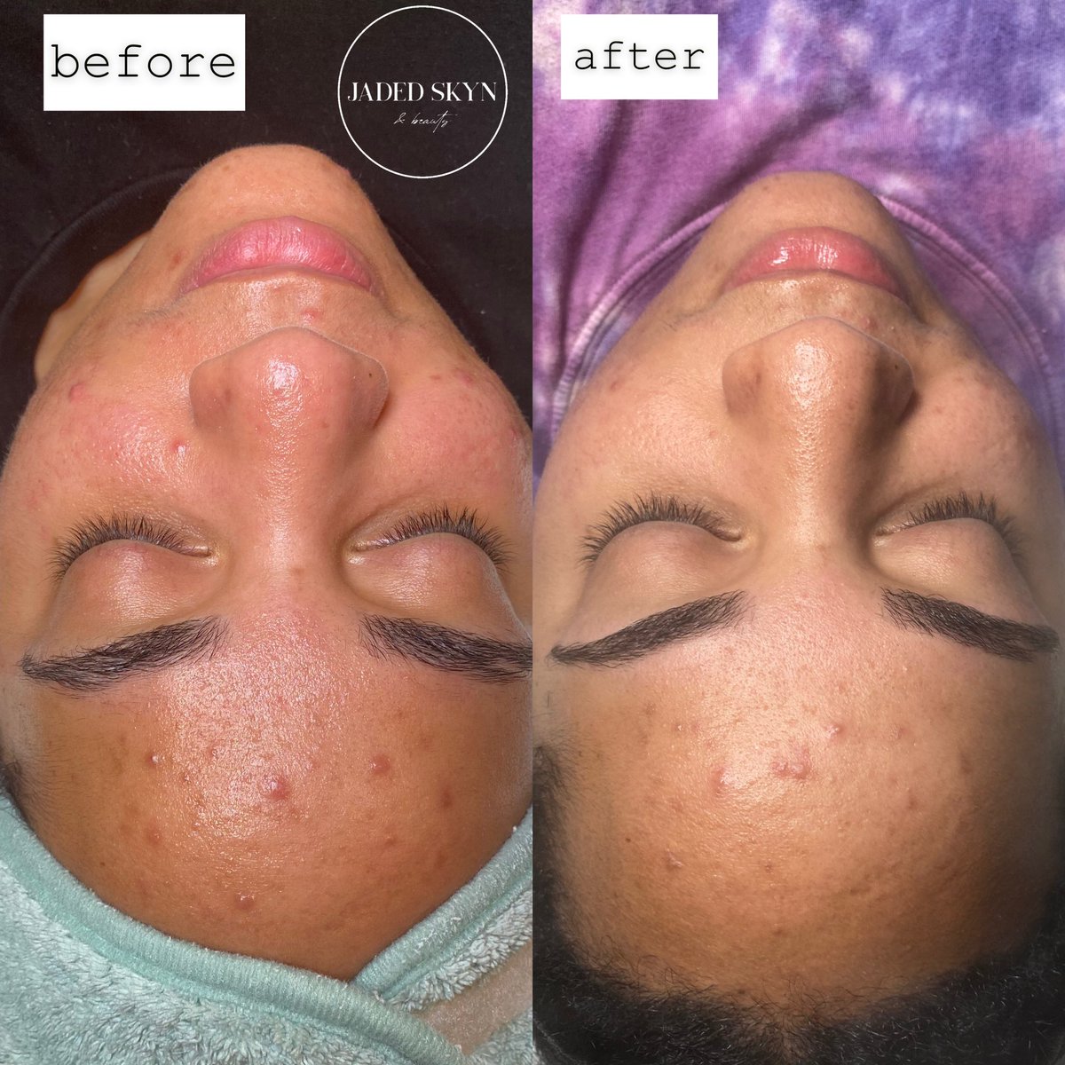hayleytheesthi's tweet photo. Men lie, women lie, my results don’t lie though. 🤪 

This is 2 weeks progress on my Acne Bootcamp. We’ve only had one session &amp; she has been on a home care routine. I can’t wait to see her end results! 💖 

#phillyesthetician #phillyfacials #phillyskincare #phillywaxing https://t.co/lyy2670Dp4