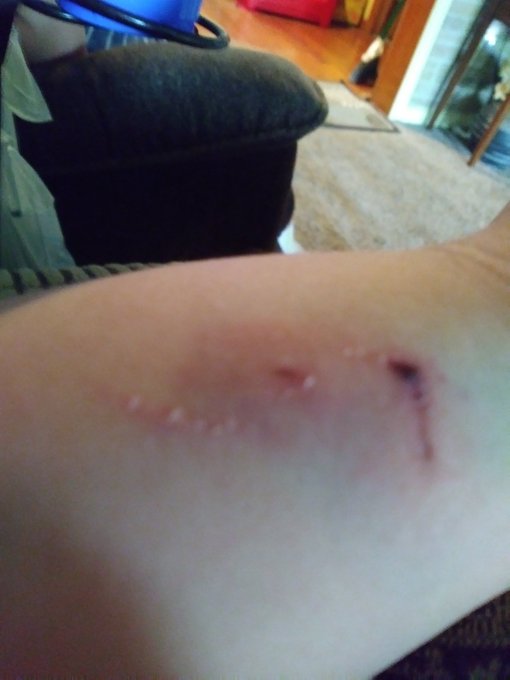 So the other day I got bit by my mom's dog it hurts bad https://t.co/qA259HhxiQ<a href="/tag/taptapfish"class="tags"><span>#taptapfish</span></a>