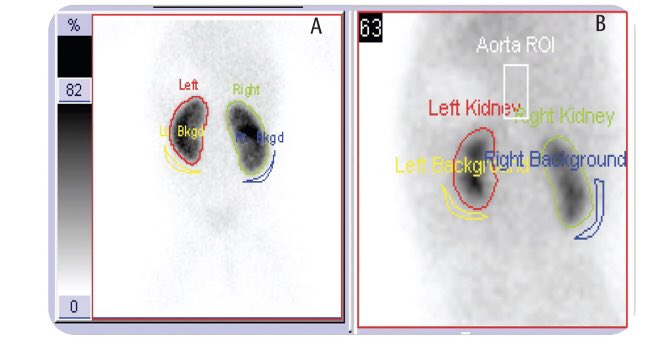 “This study shows whether there is a significant difference in the relative renal function calculation by comparing static renal scintigraphy (with DMSA) and the two most commonly applied dynamic renal scintigraphy.”
#urology #urooncology #üroloji  
jurolsurgery.org/archives/archi…