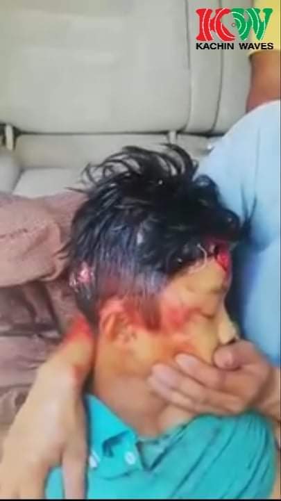 sfys_nn's tweet photo. Tw// blood// death
On May 24 around 1pm, a sixth grader kid who was feeding the chickens near the graveyard in AlinGaung ward, #MoeMauk, #Bhamo, Kachin State,was hit on the head and killed because of the artillery fired by Military terrorists.
#May24Coup
#WhatsHappeningInMyanmar https://t.co/B4caZVTfWG