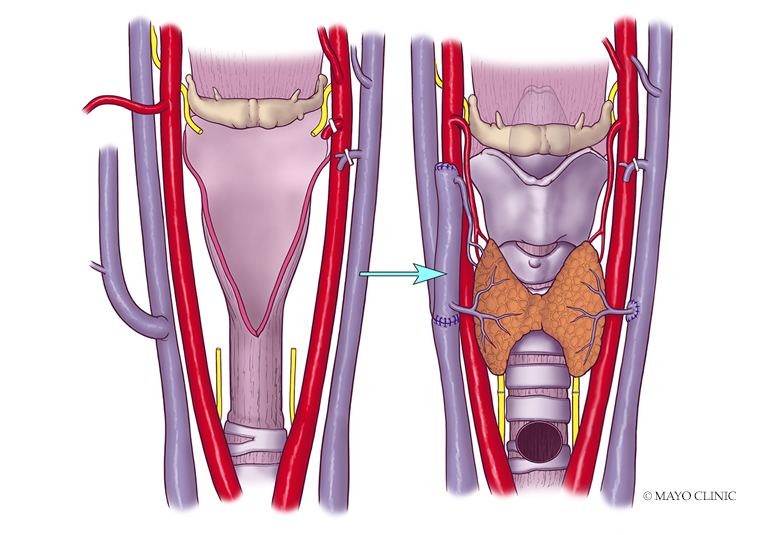MayoClinic's tweet image. New in the U.S. at Mayo Clinic's campus in Arizona: Larynx transplant program and 3D-printed prosthetic #larynx appear promising for improved quality of life for patients undergoing #laryngectomy. mayocl.in/3uYUz7T @MayoCancerCare