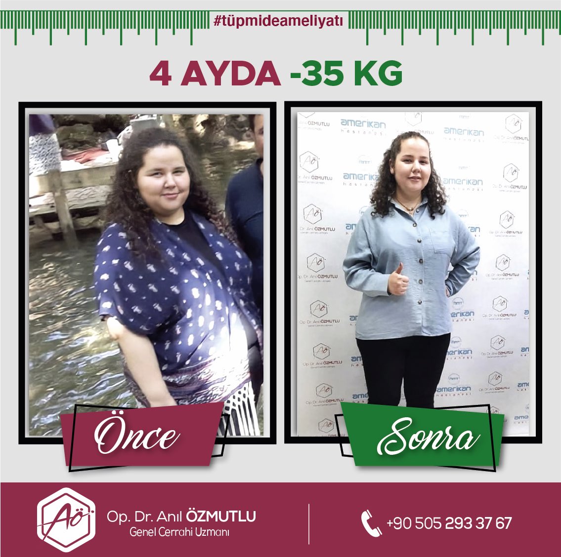 Op. Dr. Anıl Özmutlu (@opdranilozmutlu) on Twitter photo Tüp mide ameliyatı ile 4 ayda -35 kilo😊💪
.
.
Unutmayın! Obezite, önlenebilir ve tedavi edilebilir bir hastalıktır.
.
.
Ücretsiz ön görüşme ve detaylı bilgi almak için arayabilir ya da genel cerrahi kliniğimizi ziyaret edebilirsiniz.
+90 (505) 293 37 67 Tüp mide ameliyatı ile 4 ayda -35 kilo😊💪
.
.
Unutmayın! Obezite, önlenebilir ve tedavi edilebilir bir hastalıktır.
.
.
Ücretsiz ön görüşme ve detaylı bilgi almak için arayabilir ya da genel cerrahi kliniğimizi ziyaret edebilirsiniz.
+90 (505) 293 37 67