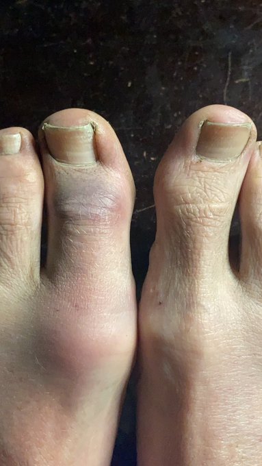 Ouch..... I broke my toe dancing in the lake... #kellisparks #sexy #milf #hurt #beachlife #toronto YOU<a href="/tag/sexy"class="tags"><span>#sexy</span></a><a href="/tag/toronto"class="tags"><span>#toronto</span></a><a href="/tag/beachlife"class="tags"><span>#beachlife</span></a><a href="/tag/hurt"class="tags"><span>#hurt</span></a><a href="/tag/milf"class="tags"><span>#milf</span></a><a href="/tag/kellis"class="tags"><span>#kellis</span></a>