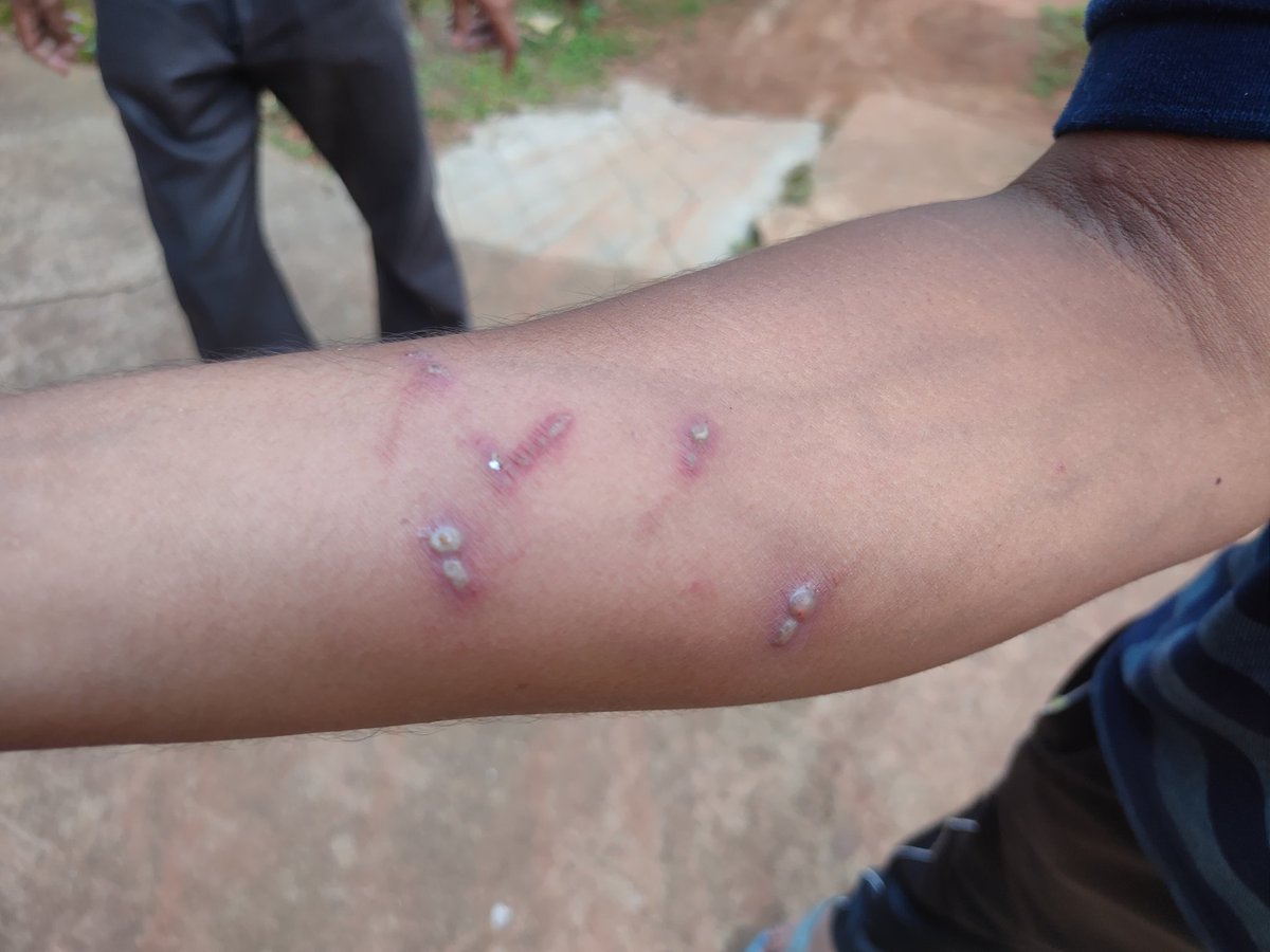 iambarsha_k's tweet photo. Dear @himantabiswa It is my brother's. It has started happening after he took his first dose of #CovishieldVaccine kindly help as we are not getting help from anyone. #CoronaVaccination #coronavirus @nhm_assam @MoHFW_INDIA @keshab_mahanta https://t.co/rYOo1vWUJB